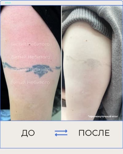 Удаление татуировки